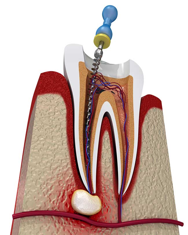 root-canals-miles-city-mt-endodontic-treatment-yerger-family-dental